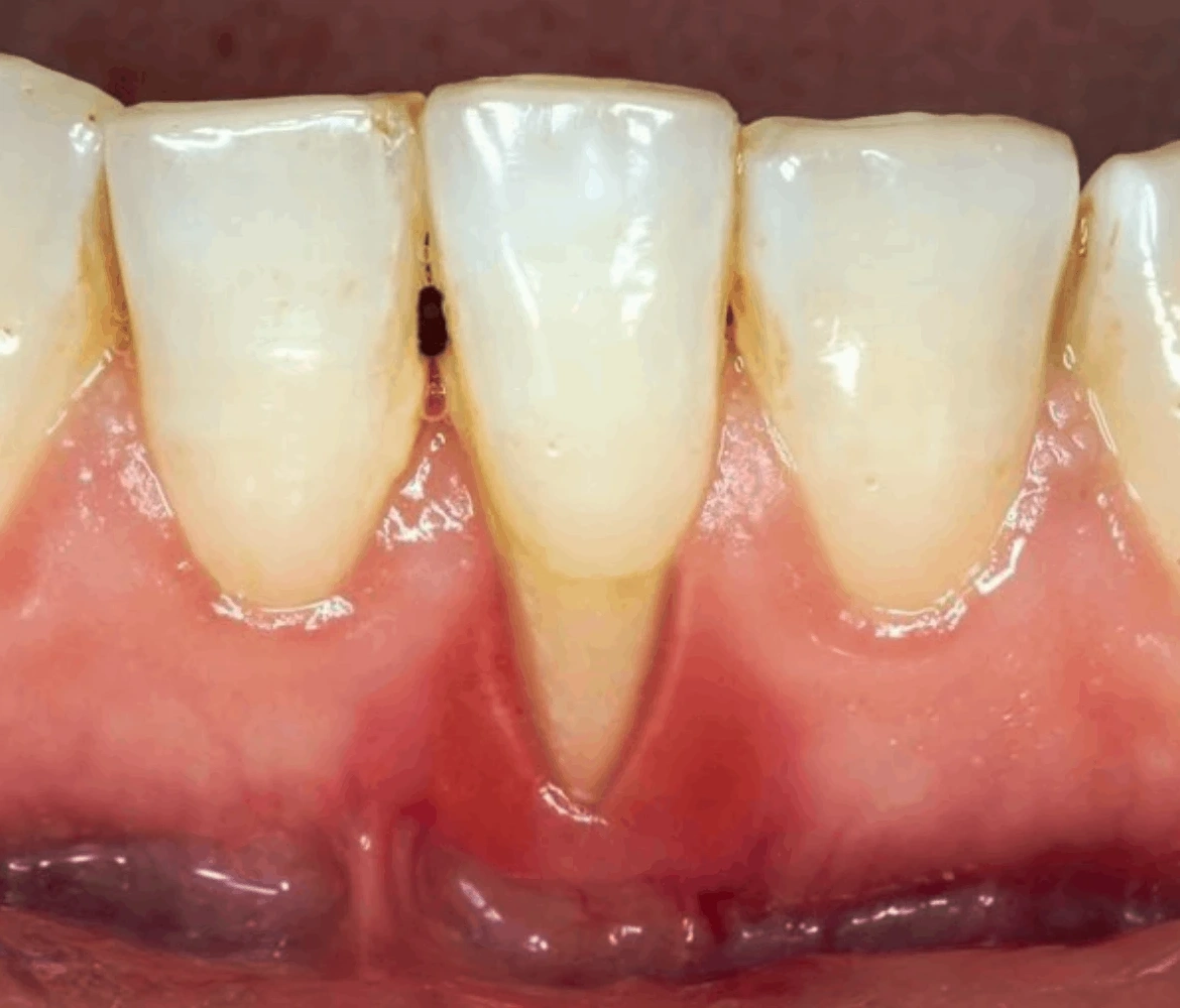 Bọc răng sứ bị tụt lợi: Nguyên nhân, tác hại & giải pháp điều trị